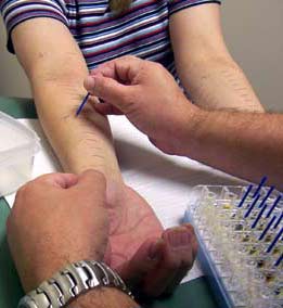 Allergy skin test