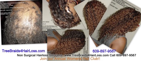 TreeBraids4HairLoss.com- Hair Club For Women.