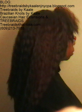TreeBraids4HairLoss.com- Non-Surgical Hair Loss Solutions at Kaales, Right side.
