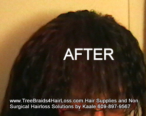 TreeBraids4HairLoss.com- Non-Surgical Hair Loss Solutions at Kaales, Top.