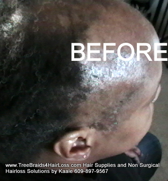 TreeBraids4HairLoss.com- Non-Surgical Hair Loss Solutions at Kaales, Right side.