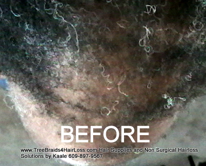 TreeBraids4HairLoss.com- Non-Surgical Hair Loss Solutions at Kaales, BEFORE Top.