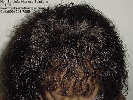 Hair loss male pattern baldness reversed.