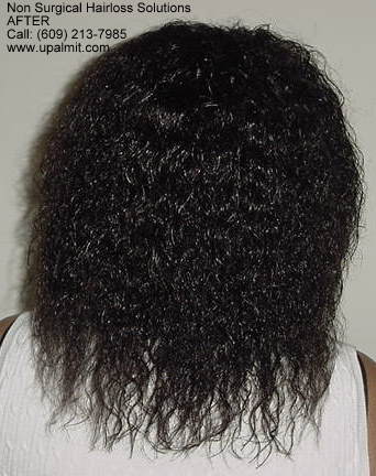 Hair loss reversed with bang- back view after treebraids.