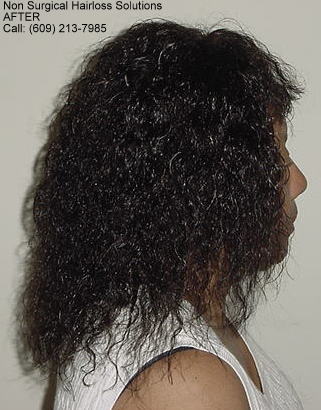 Hair loss reversed with bang- side view after treebraids.