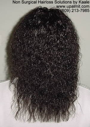 Hair loss back view after treebraids.