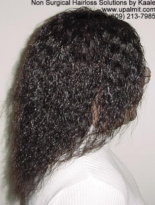 Hair loss side view after treebraids.