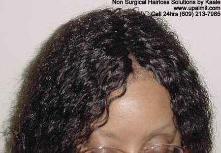 Hair loss top view after treebraids.