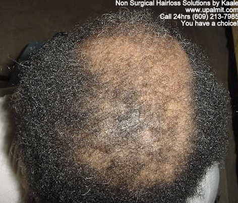 Hair loss before non surgical hair loss solutions.
