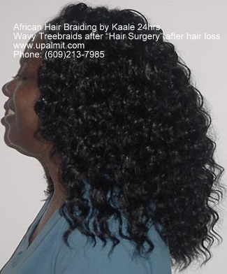 Hair loss side view after treebraids.