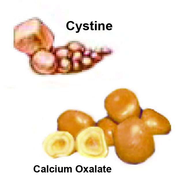 Calcium Oxalate & Cystine Stones