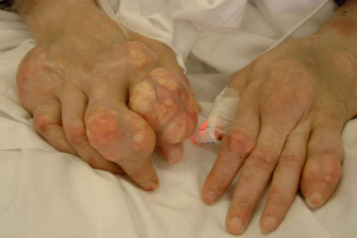 gouty hand