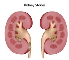 kidney stones
