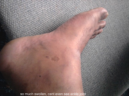 ankle gout