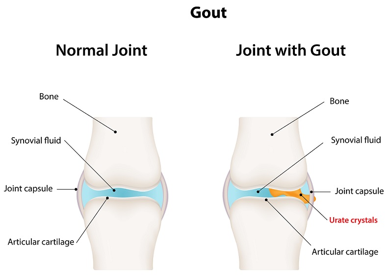 gout in the joints