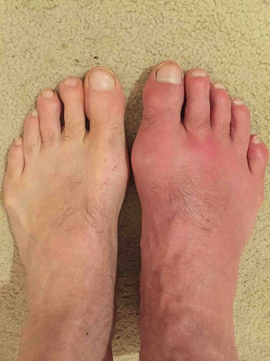 gout in the foot