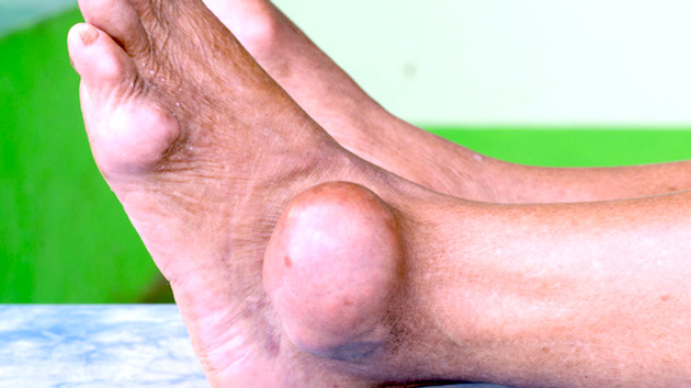 gout in ankle