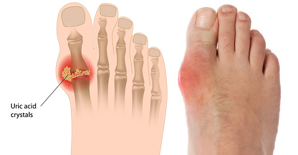 gouty toe