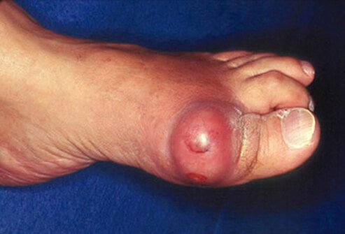 gout in big toe