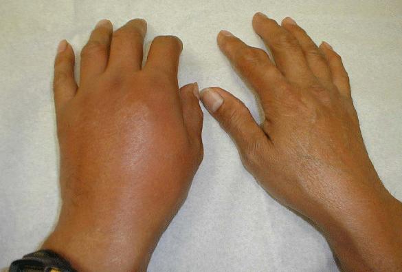 gout hands