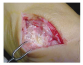 gout in knee