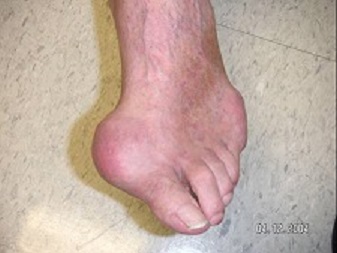 gouty feet