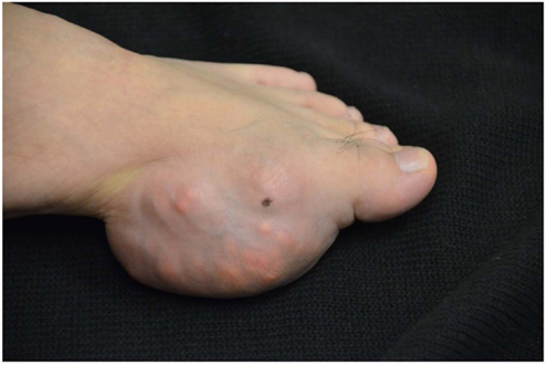 gross gout