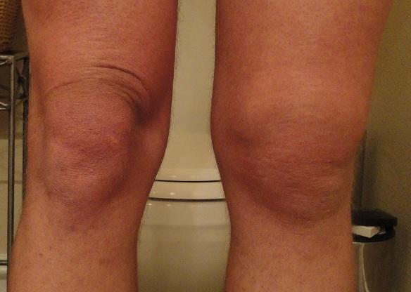 gouty knee