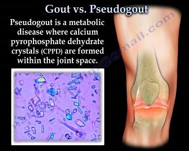 pseudogout