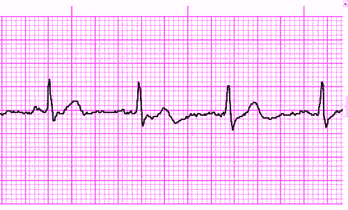 Sample of ECG captured